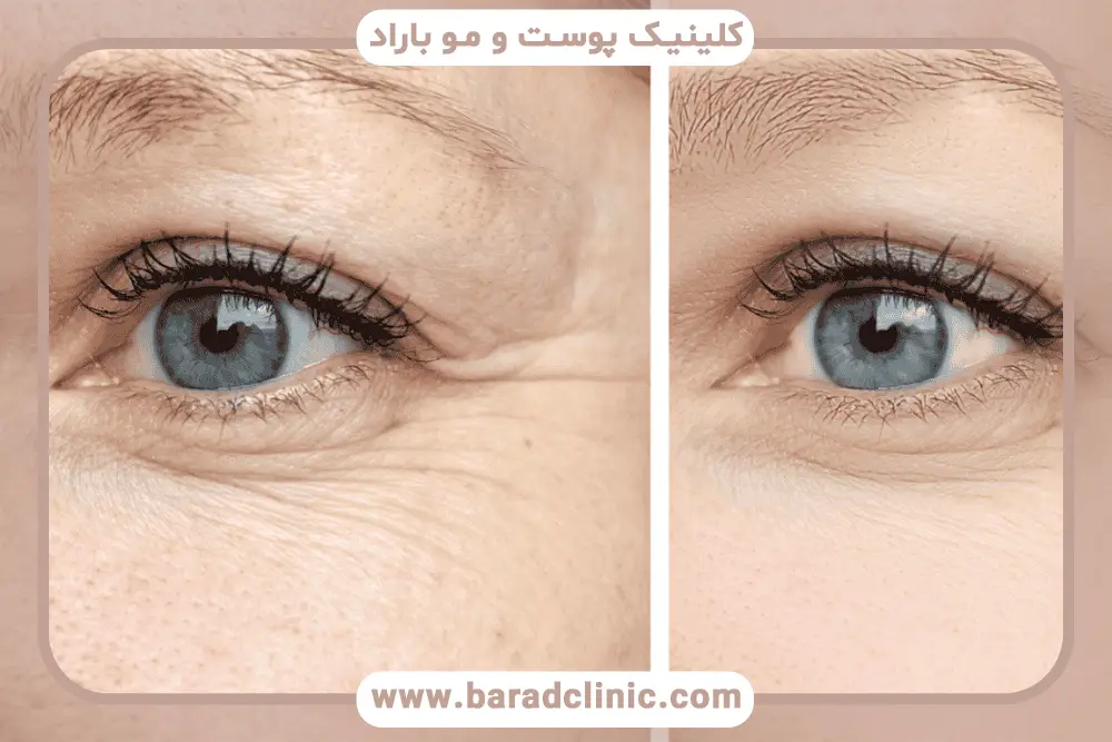 روش صحیح برداشتن چسب بلفاروپلاستی 