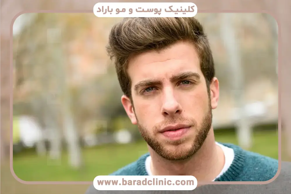 محدودیت‌های روش fit کاشت مو