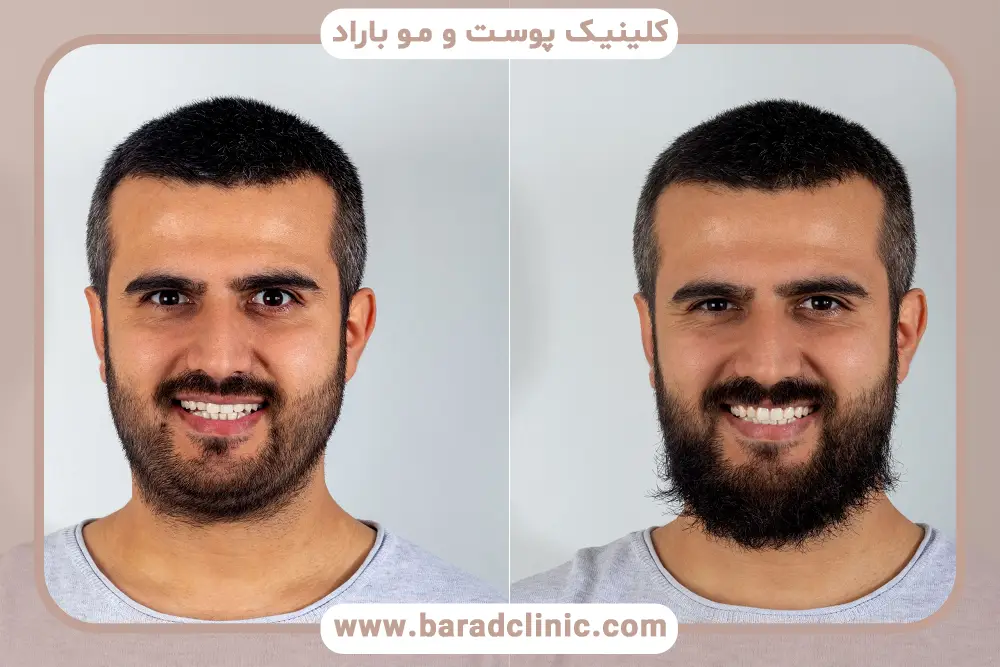 کاشت ریش نظرات درباره بهترین سن