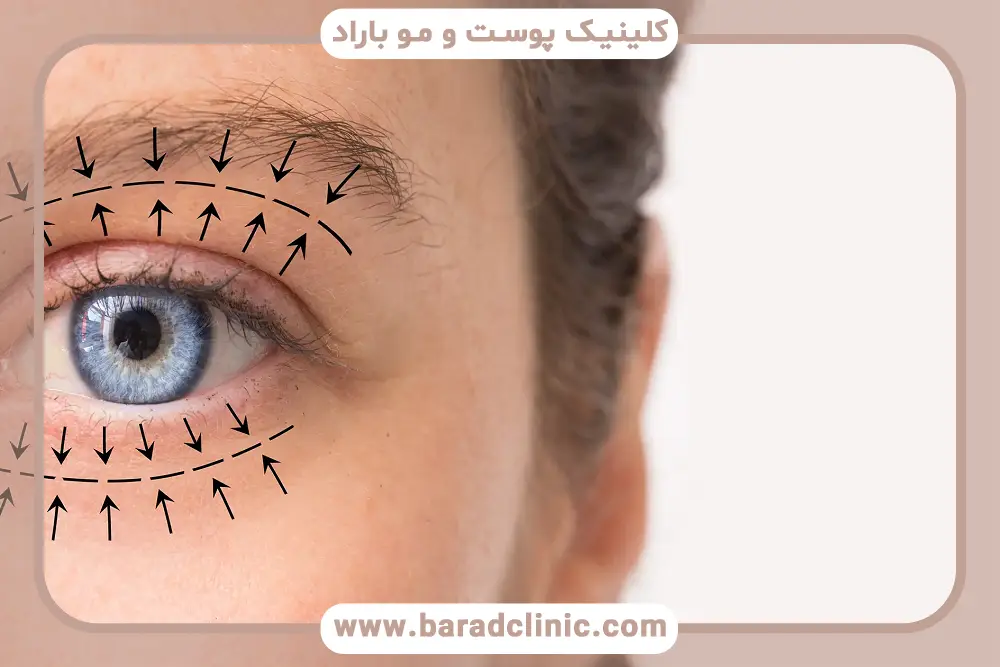 بررسی نتایج اولیه یک ماه بعد از عمل بلفاروپلاستی