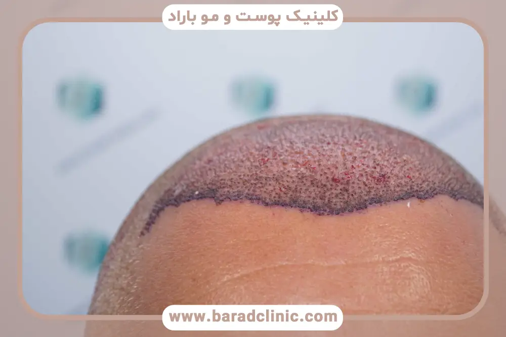 استفاده از کلاه برای محافظت در برابر نور آفتاب بعد از کاشت مو