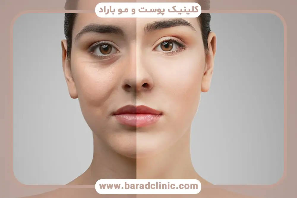 مزایای بلفاروپلاستی چهار پلک