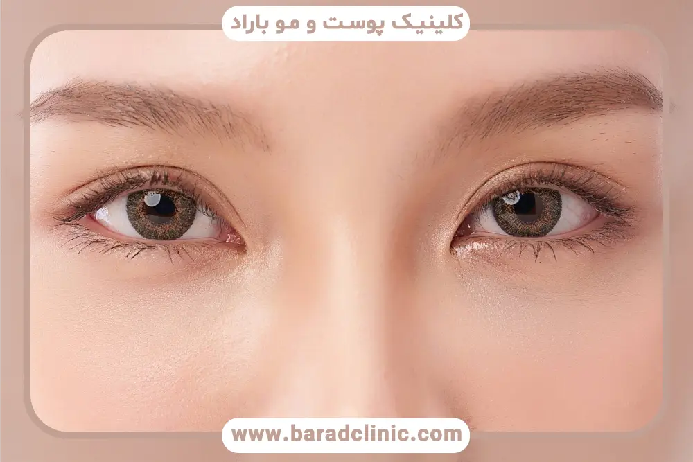 مزایای بلفاروپلاستی با لیزر co2