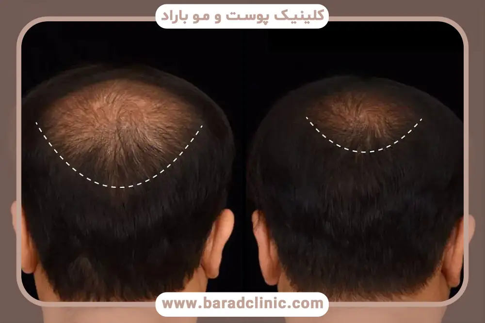 کاندیدای مناسب جدیدترین روش کاشت مو بدون بانک مو