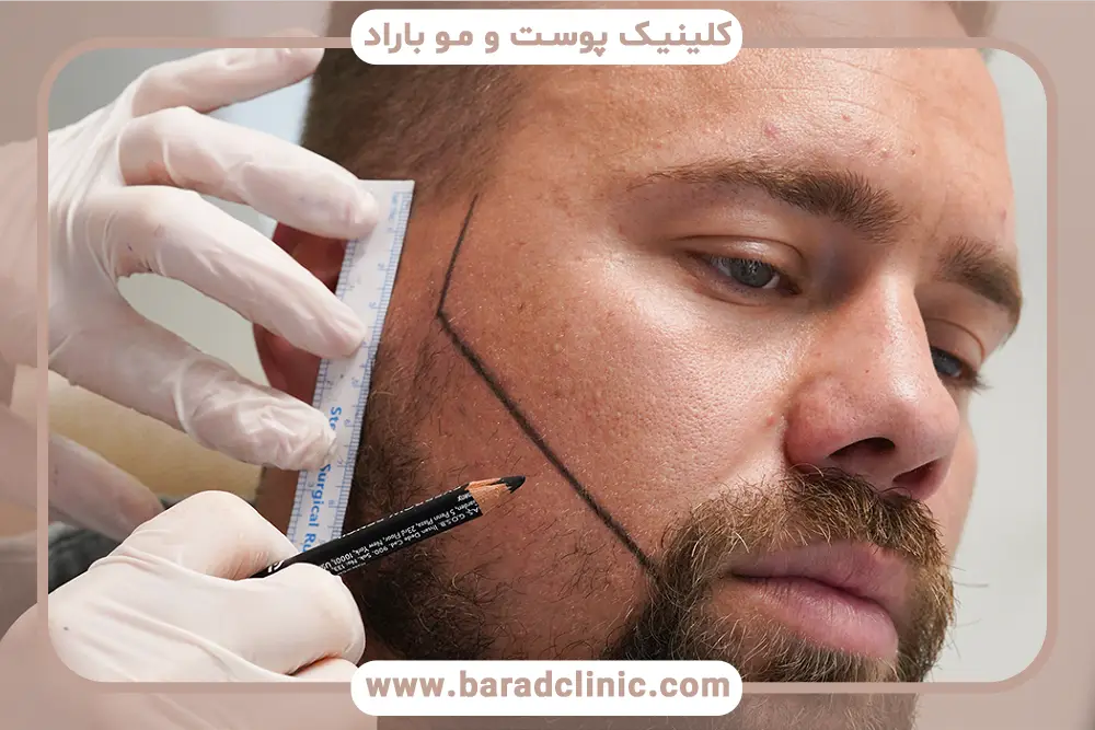 مراحل کاشت ریش وی ای پی 