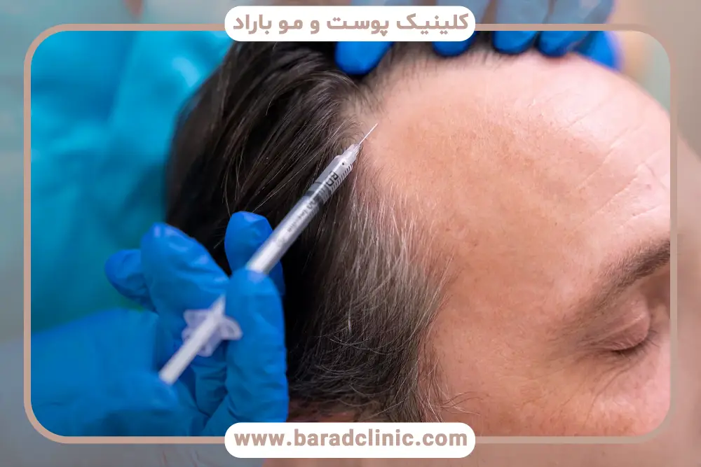 تاثیر مزو تراپی بعد از کاشت مو بر کاهش ریزش موها