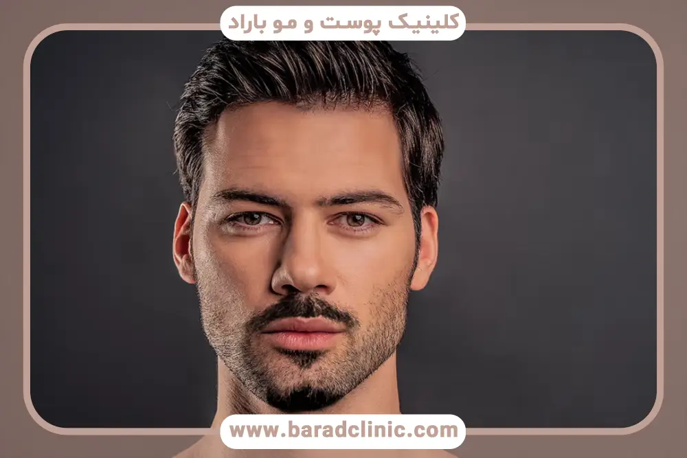 مراحل کاشت ریش چانه