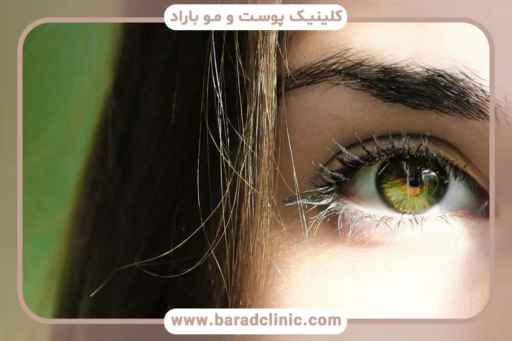 مزوتراپی جایگزین بلفاروپلاستی