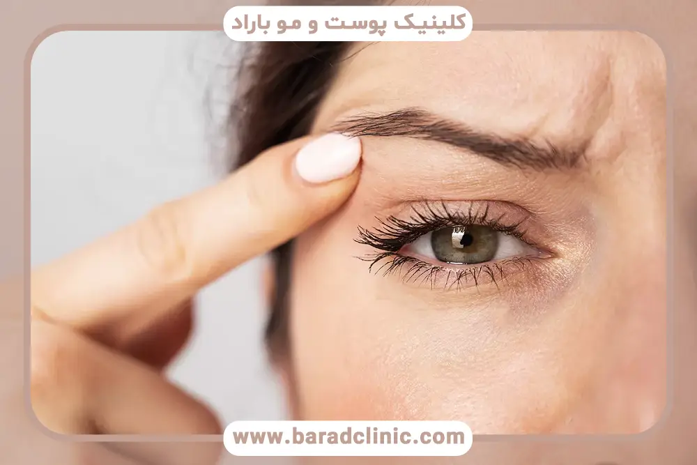 تفاوت بلفاروپلاستی سنتی و لیزری