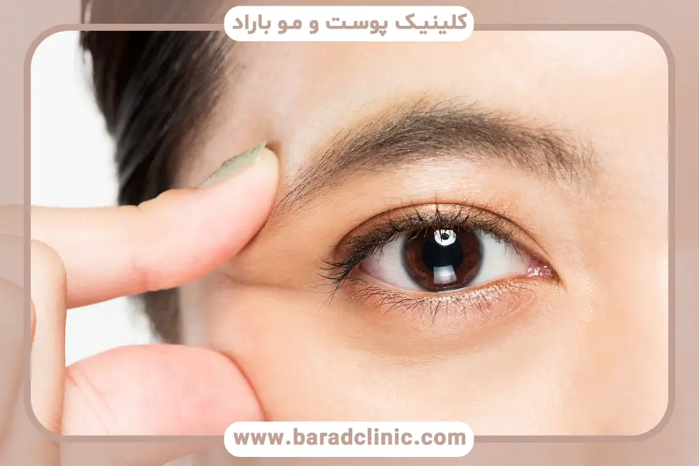 مراحل بلفاروپلاستی ترمیمی 