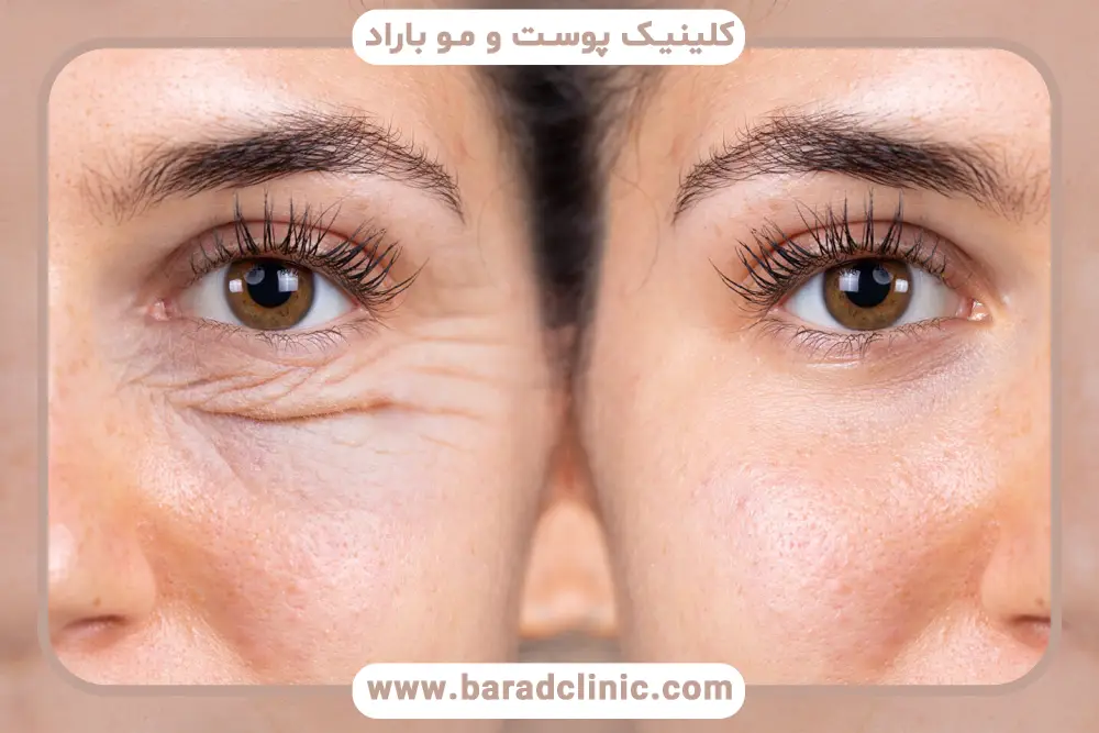 مراحل بلفاروپلاستی ترانس کونژ