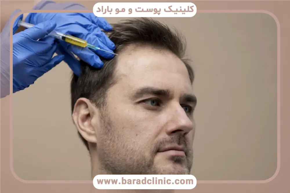 اطلاعات در تصاویر کاشت مو