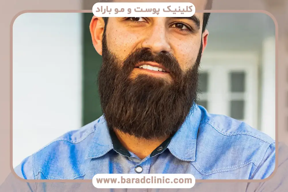 روشهای رایج کاشت ریش جای سوختگی