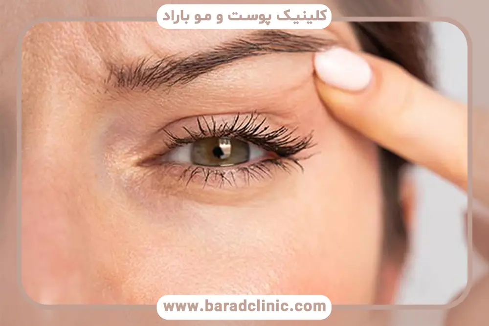 تاثیر سبک زندگی روی ماندگاری بلفاروپلاستی