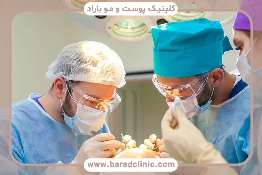 کاشت مو چند ساعت طول میکشد؟ تاثیر تعداد گرافت