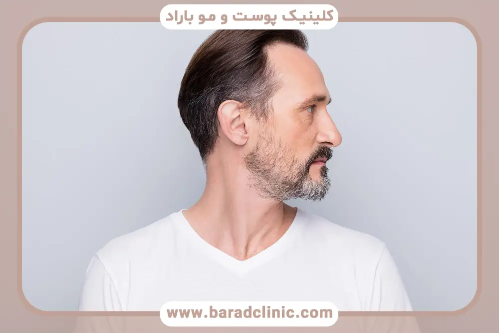 مزایا و معایب کاشت ریش با لیزر