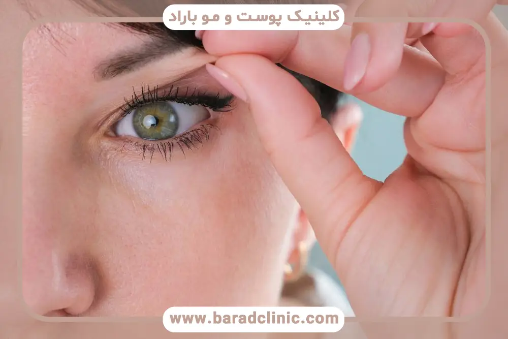 مدارک لازم برای بلفاروپلاستی اقساطی