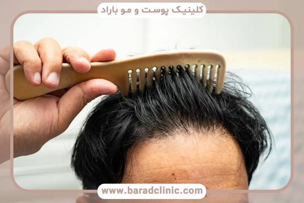 مراحل کاشت مو به روش dhi