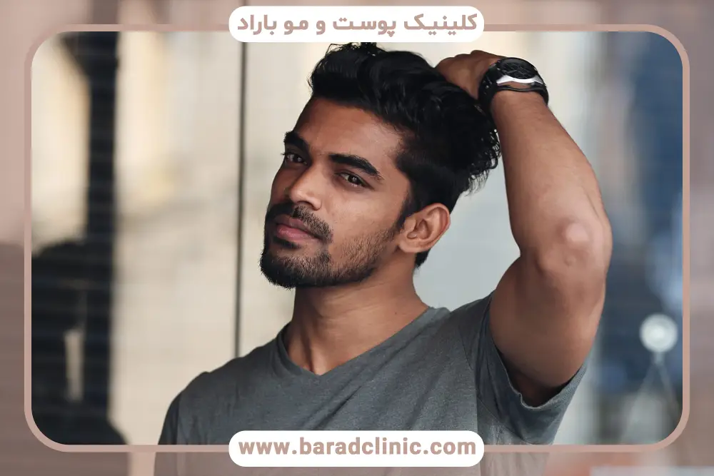 مدلهای کاشت ریش مردانه