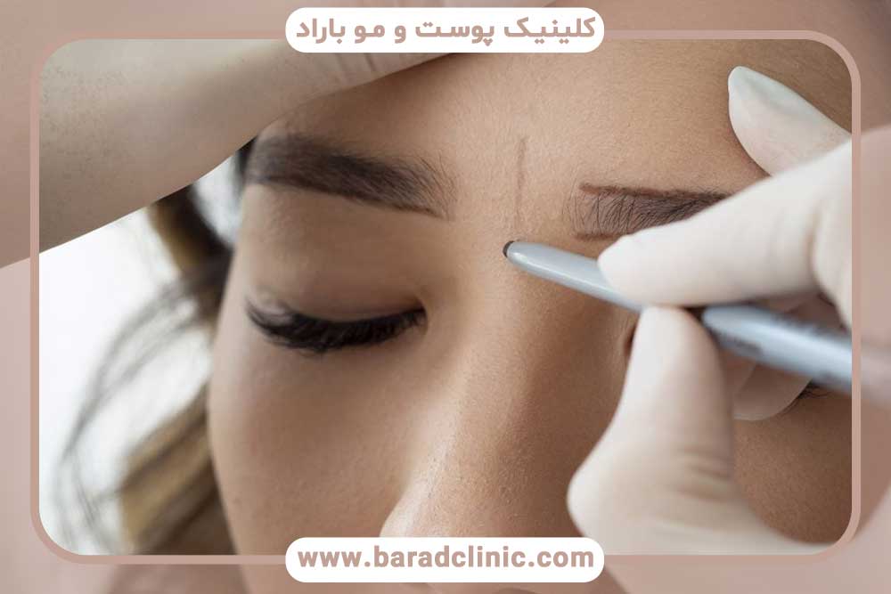 کاشت ابرو جاهای خالی