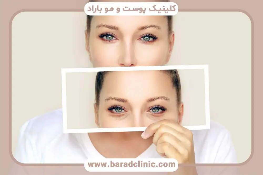 روند بهبودی در عکس بلافاصله بعد از عمل بلفاروپلاستی