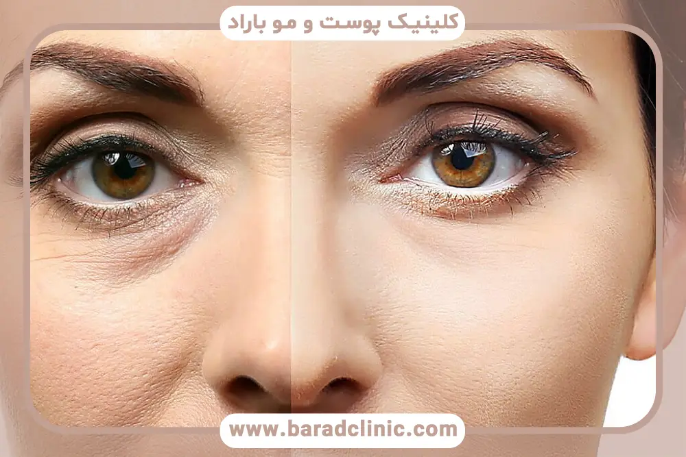 مدت زمان طول کشیدن احساس کشیدگی پلک بعد از بلفاروپلاستی
