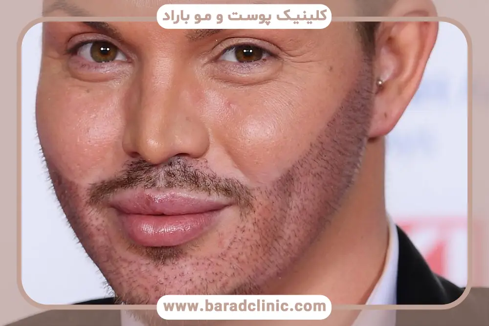 مراقبت‌های بعد از جدیدترین روش کاشت ریش