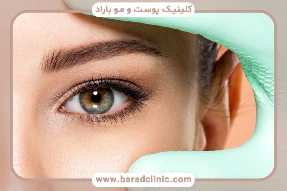 کاشت ابرو با جراحی یا بدون جراحی