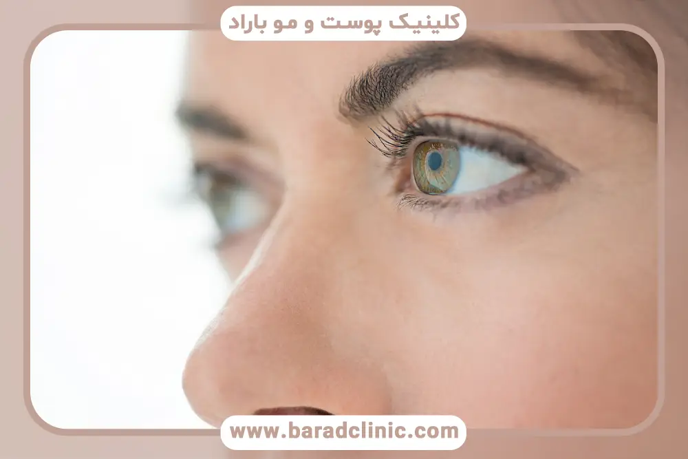 آمادگی قبل از بلفاروپلاستی چشم 