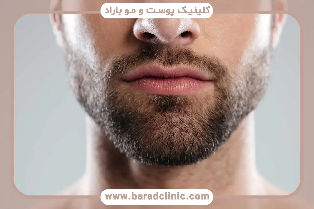 مراقبت‌های بعد از کاشت ریش مردان