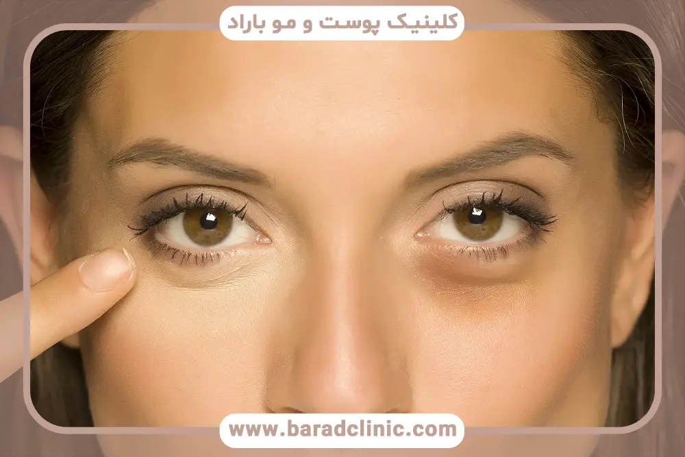 نتایج بلفاروپلاستی پف زیر چشم 