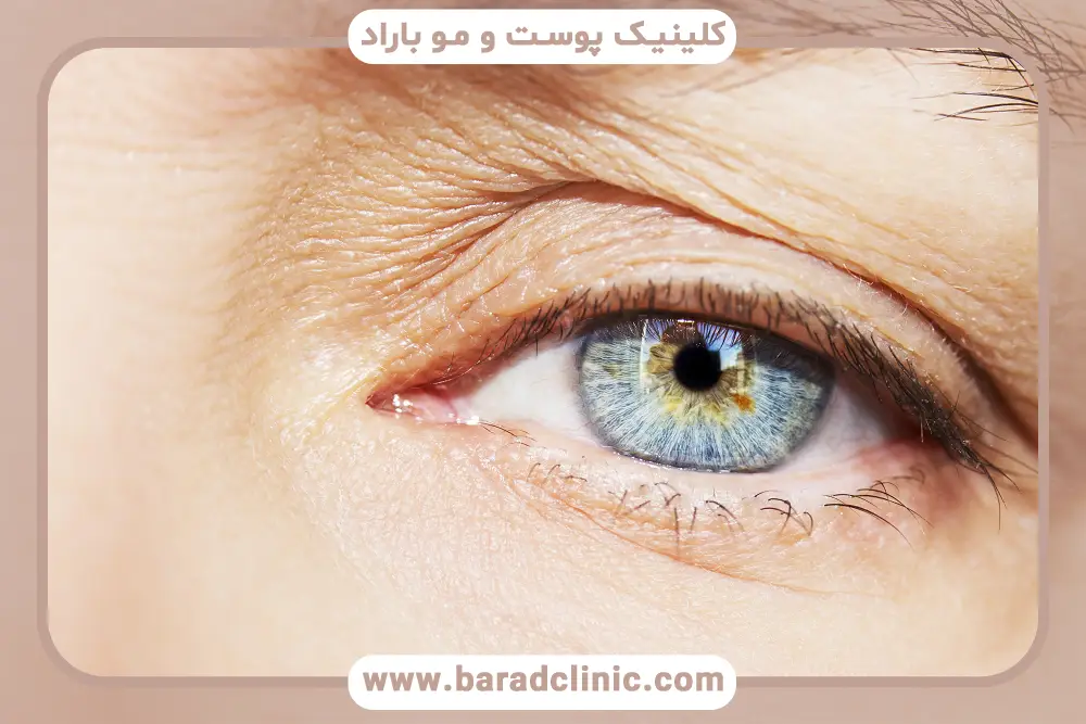 عوارض احتمالی بلفاروپلاستی پلک بالا 