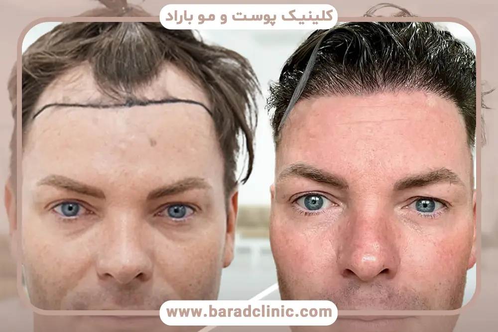 روش DHI از انواع کاشت مو 