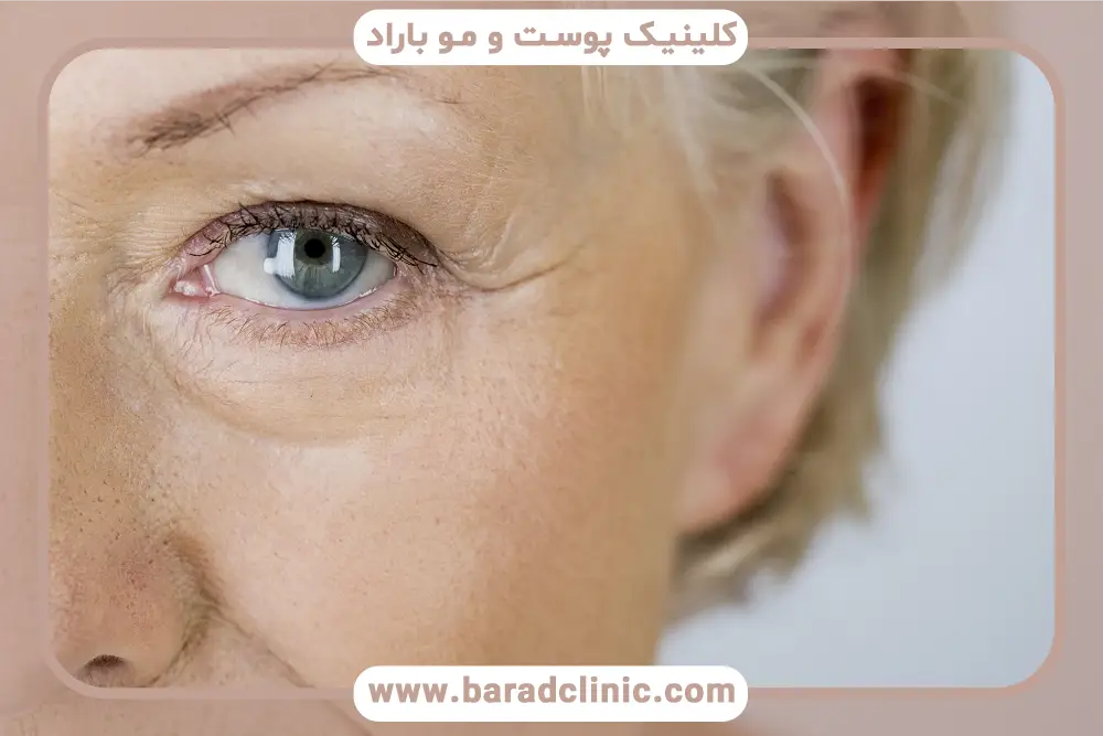 مدت زمان بلفاروپلاستی پلک