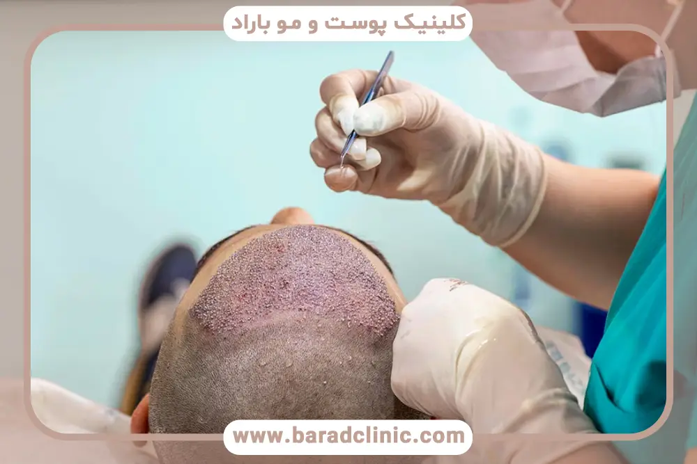 هزینه‌های بهترین کلینیک کاشت مو در تهران از نظر مردم 