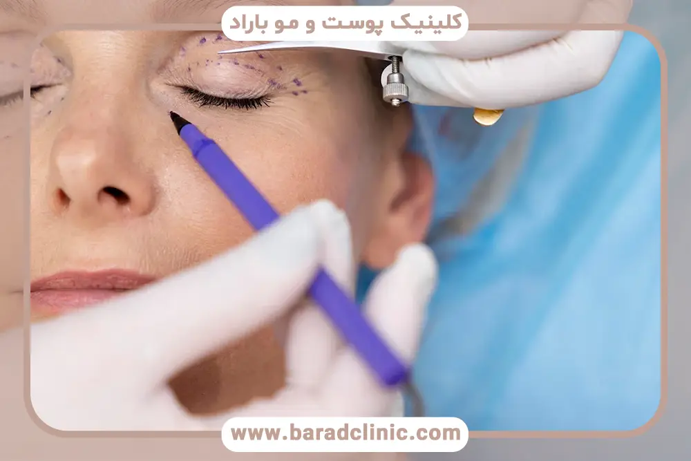 چگونگی عمل بلفاروپلاستی  و تکنیک‌های جراحی