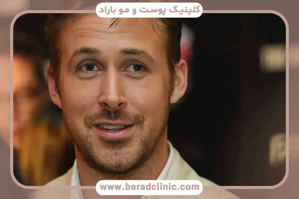 دلایل نیاز به کاشت ریش موقت 