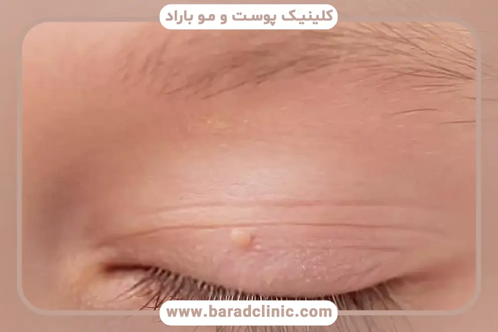 درمان‌های خانگی گوشت اضافه بعد از بلفاروپلاستی 