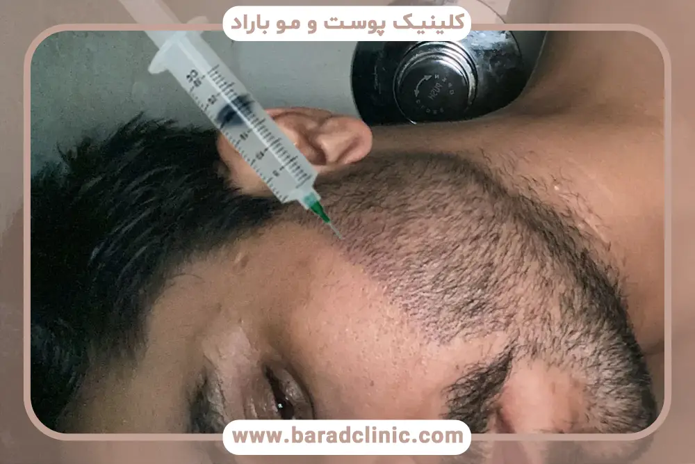 عوارض احتمالی کاشت ریش با نیدل 