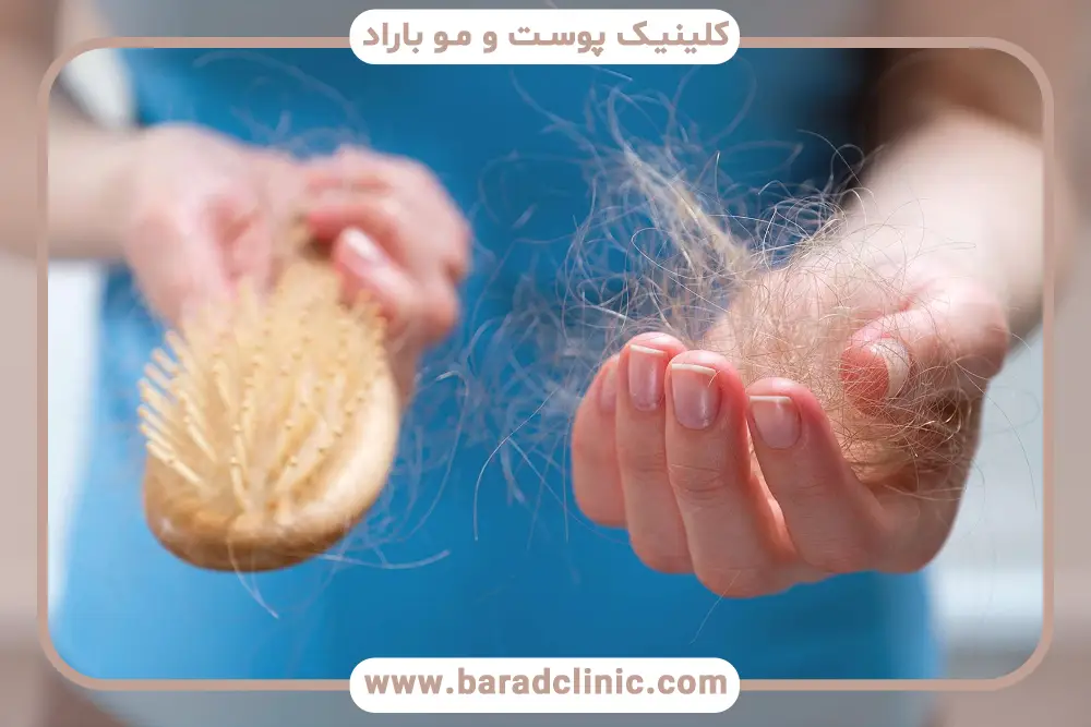 جلوگیری از ریزش مو در تنبلی تخمدان با رژیم غذایی سالم