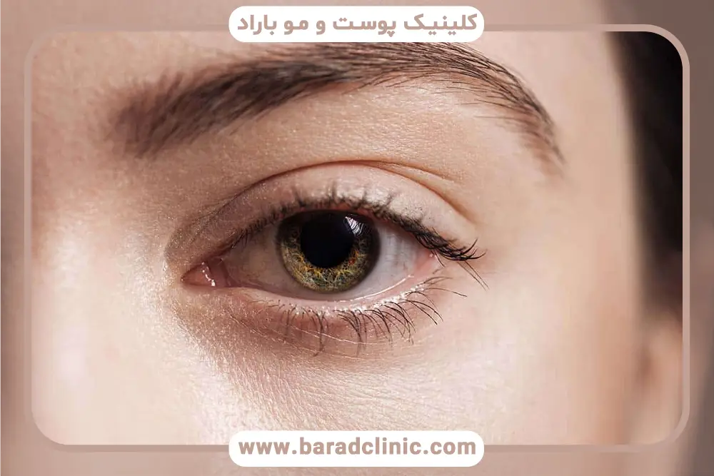 شرایط انجام بلفاروپلاستی توسط چشم پزشک