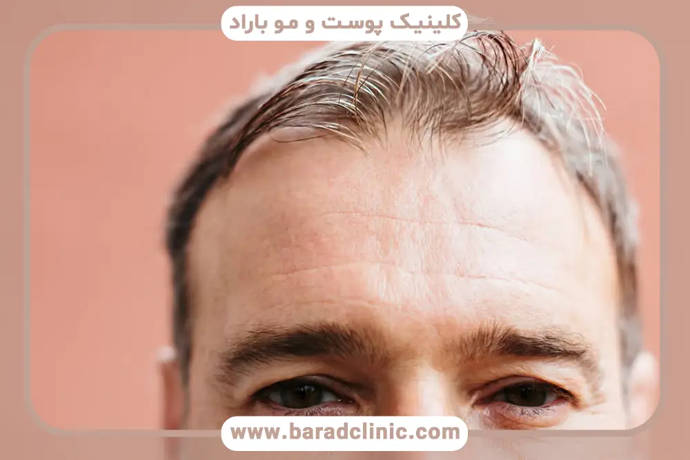 داروهای موثر برای جلوگیری از ریزش مو تستوسترون