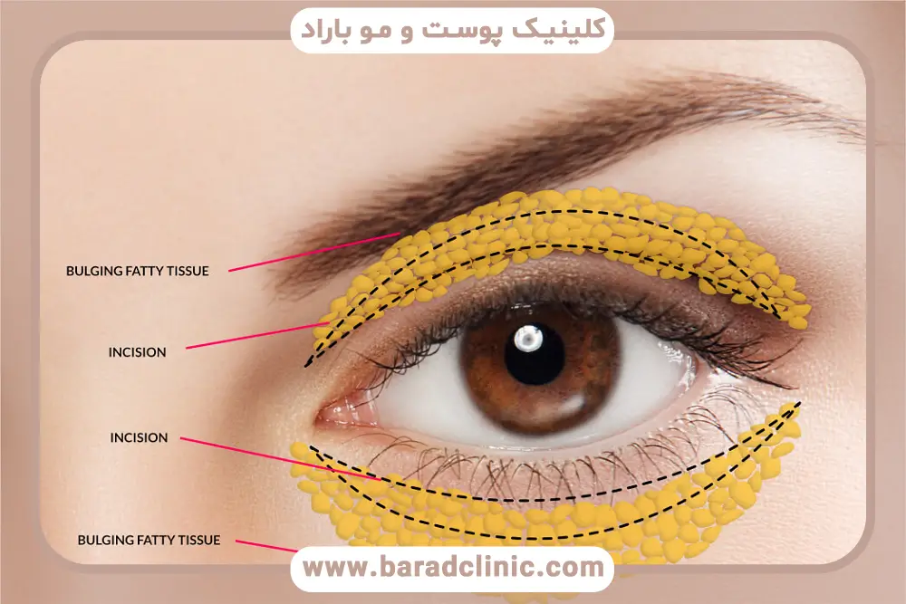 اشتباهات رایج در برداشتن چسب بلفاروپلاستی 