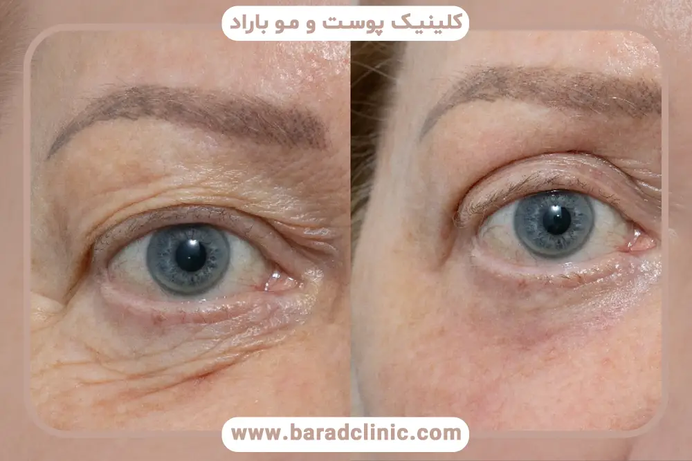 تاثیر سبک زندگی روی نتایج یک ماه بعد از عمل بلفاروپلاستی