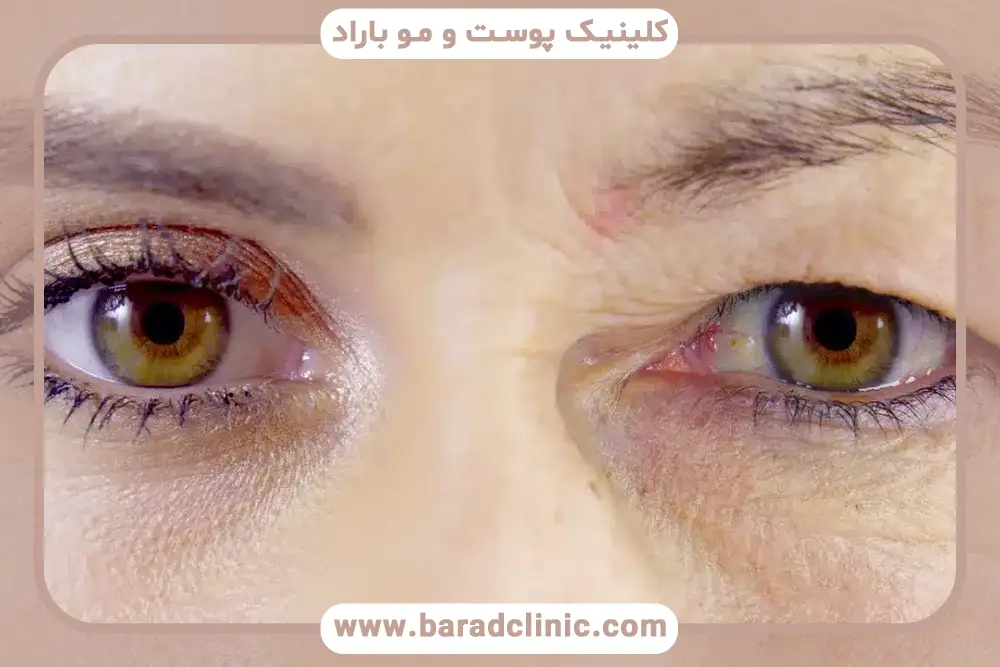 پیشگیری از افتادگی پلک