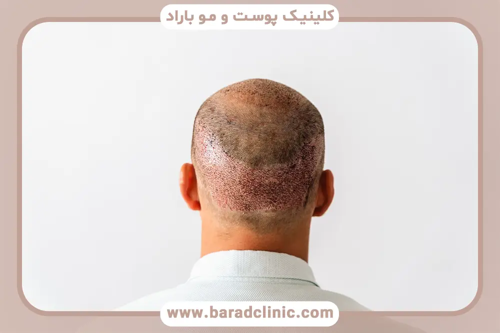 تاثیر نور آفتاب بعد از کاشت مو روی رویش موها