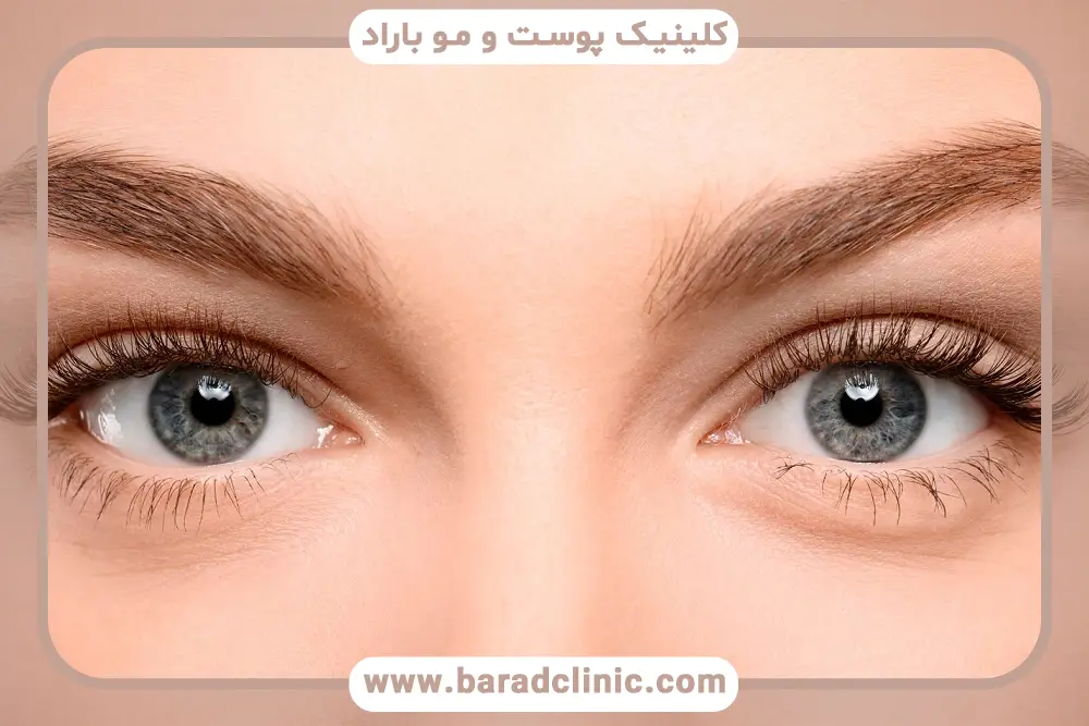مراقبت‌های قبل از بلفاروپلاستی چهار پلک
