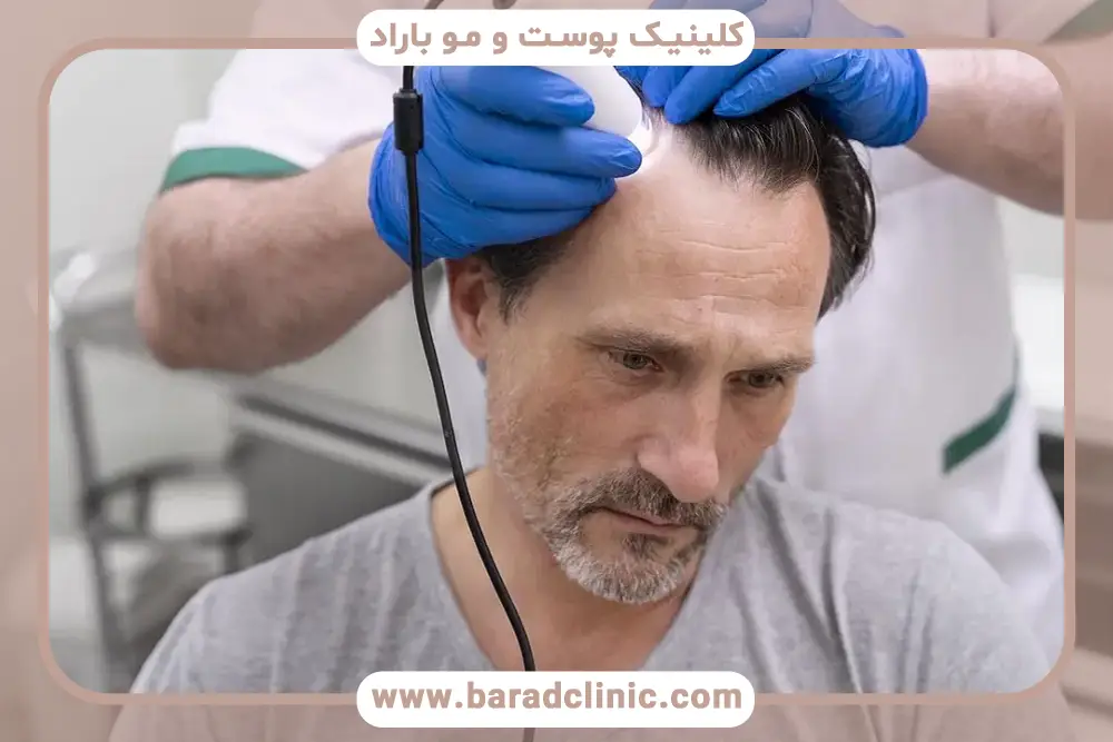 محدودیت‌های جدیدترین روش کاشت مو بدون بانک مو