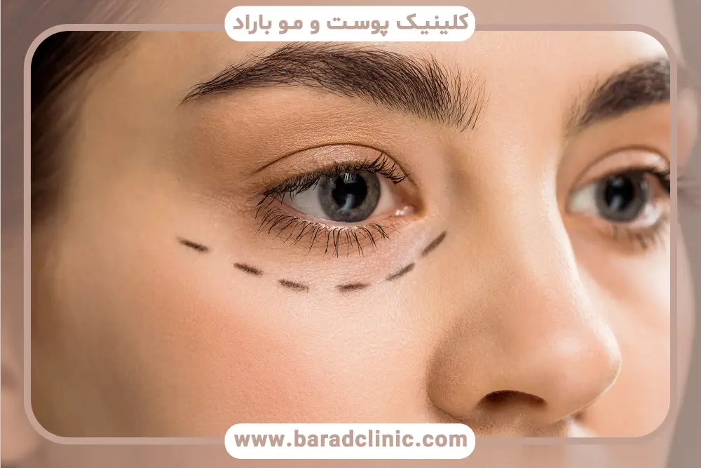 نکات مهم در نمونه‌های بلفاروپلاستی قبل و بعد