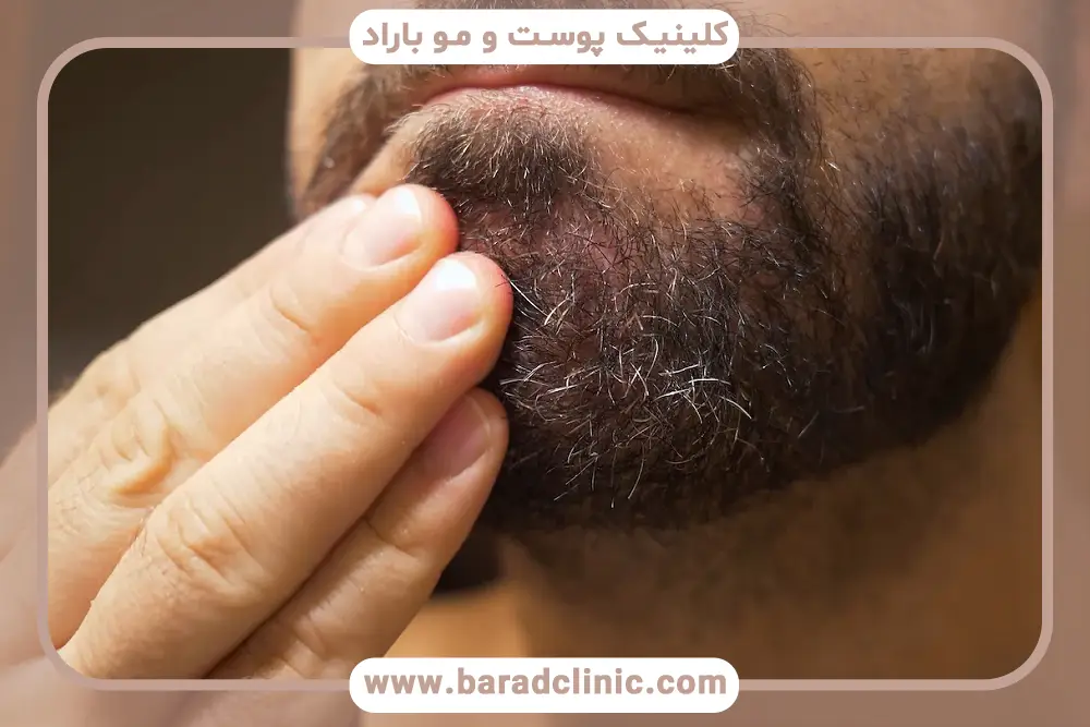 مراجعه به پزشک بعد از خارش بعد از کاشت ریش